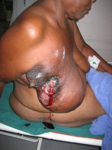 A woman in Zimbabwe with advanced breast cancer